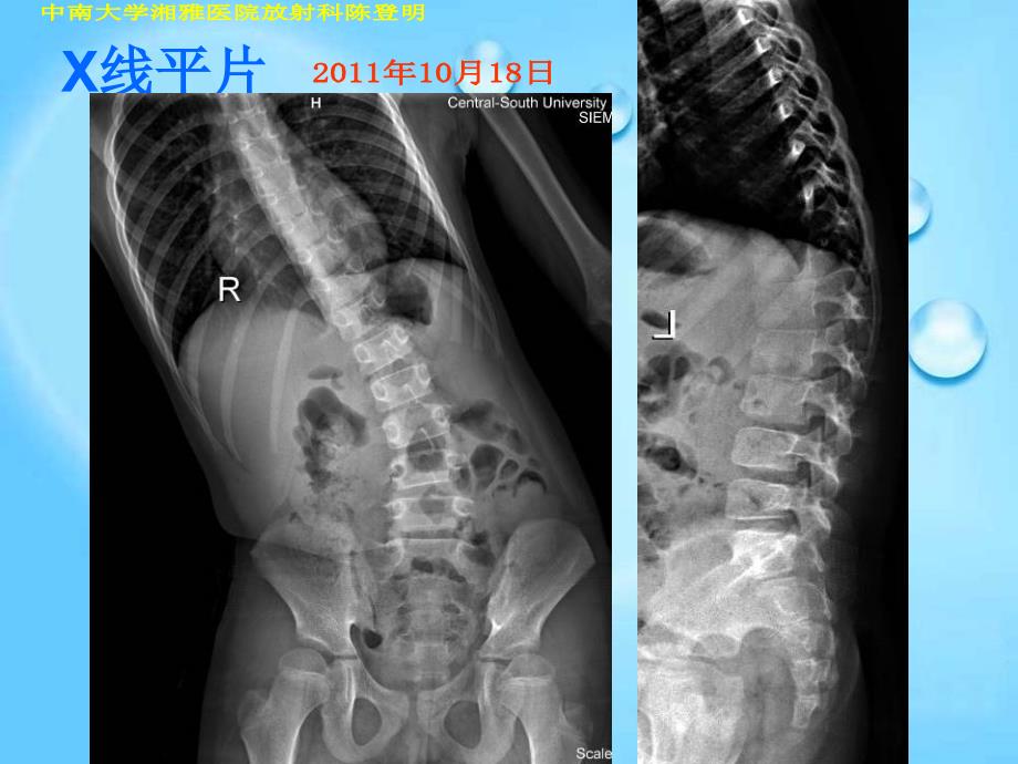 许莫氏结节典型影像_第3页