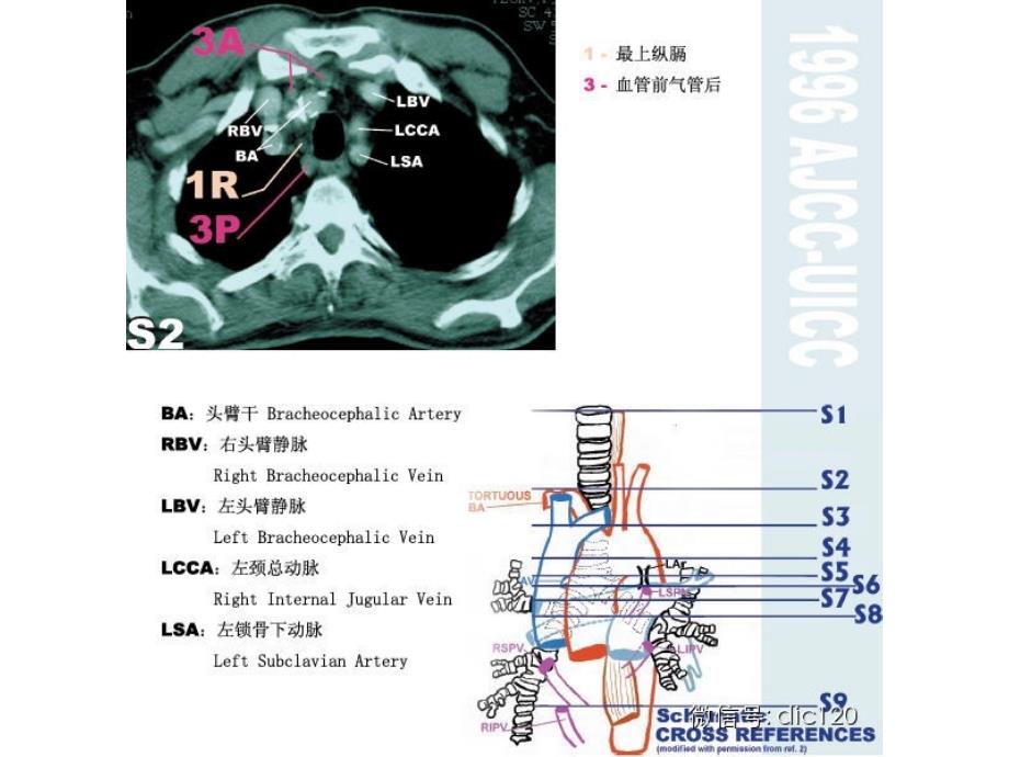 纵膈淋巴结分区图谱详解_第4页