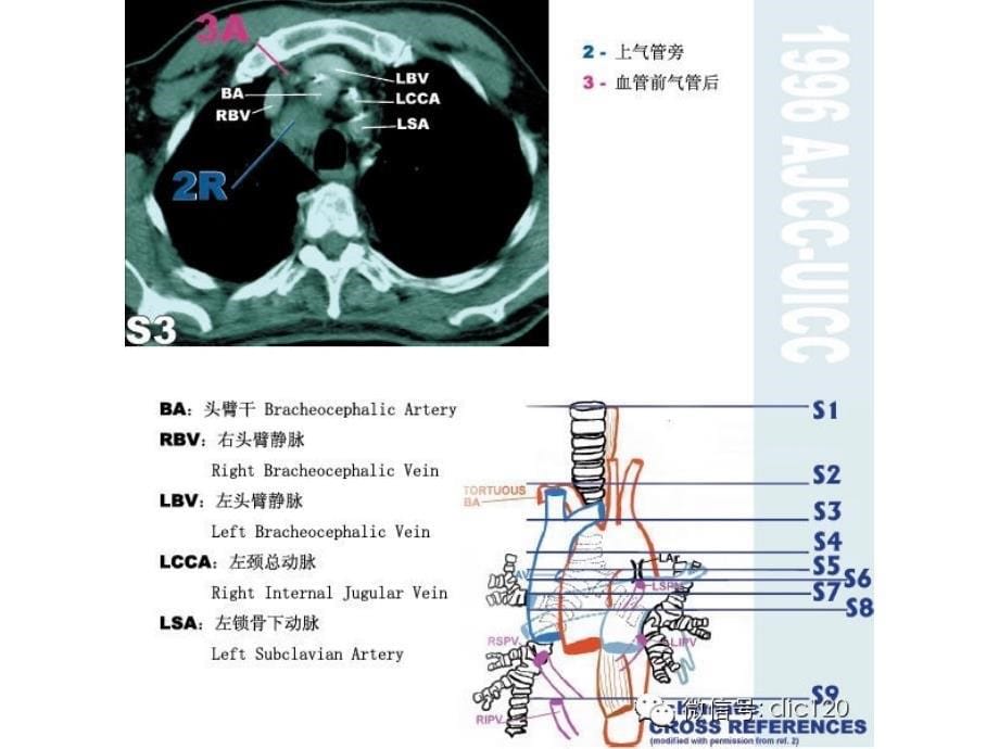 纵膈淋巴结分区图谱详解_第5页