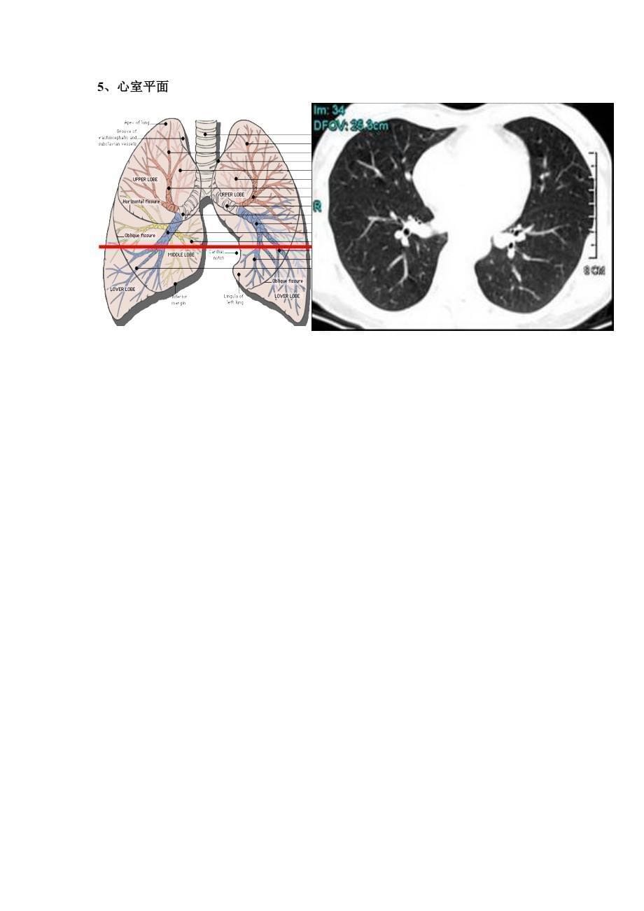 肺部ct口诀及支气管树_第5页