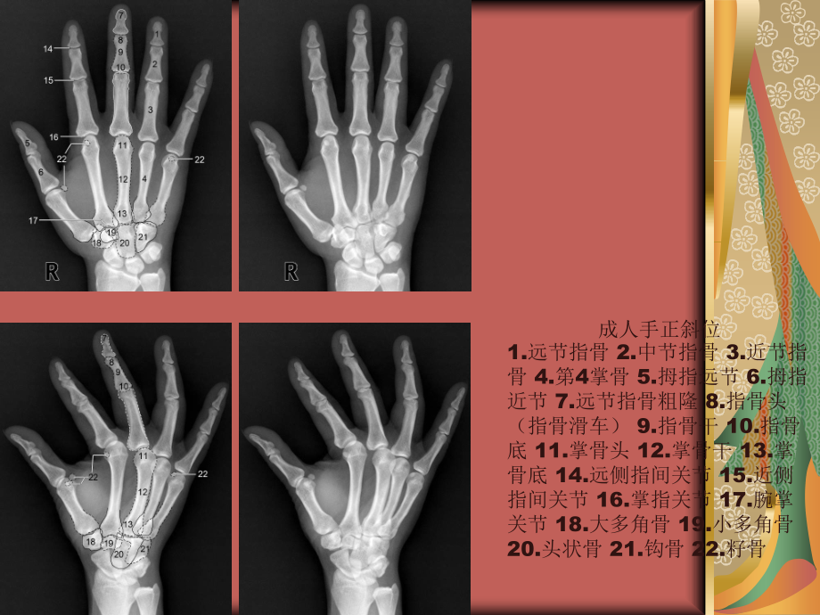 四肢骨关节正常变异与常见病及创伤的影像表现_第3页