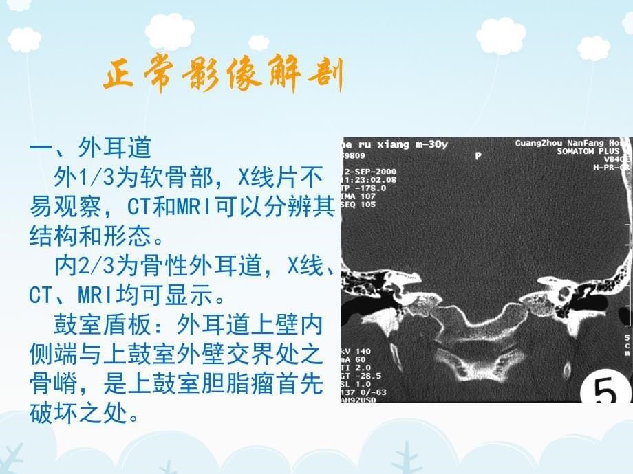 医学影像-耳的影像解剖及常见疾病诊断_图文_第5页