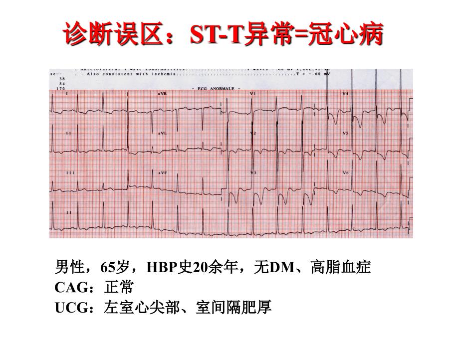 动态心电图：急性心肌缺血评价_第2页