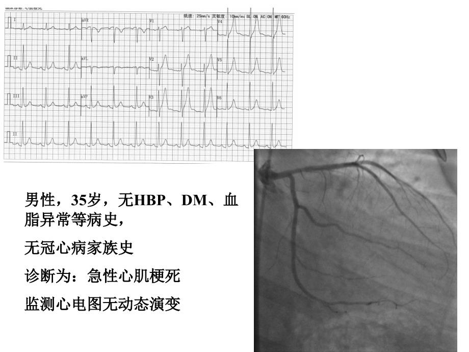 动态心电图：急性心肌缺血评价_第3页