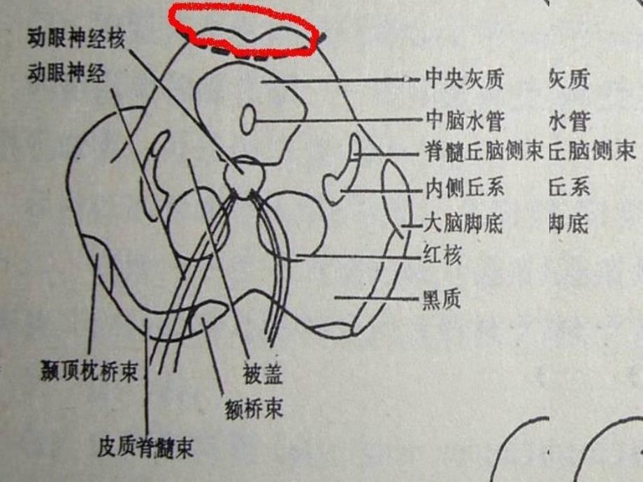 神经病学常见的脑干损害综合征_第3页