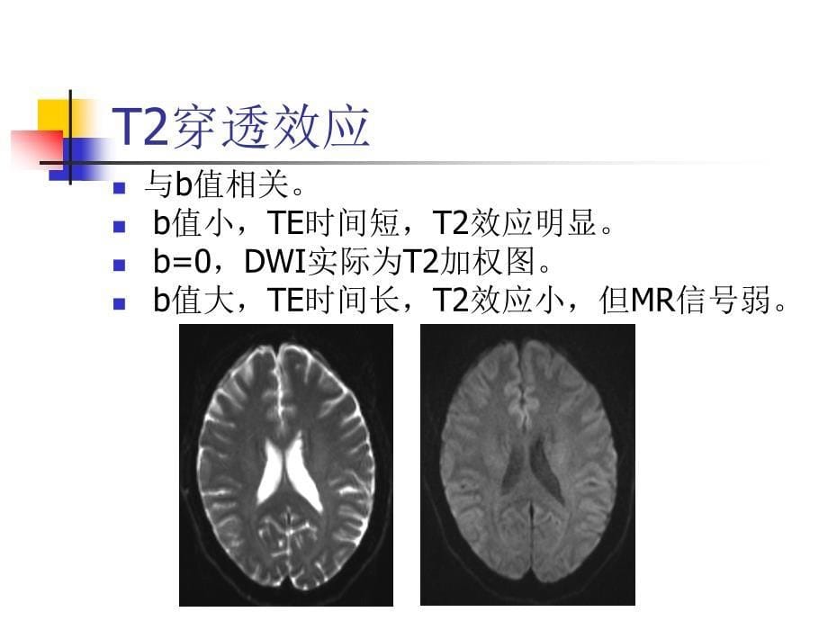 dwi对颅脑疾病鉴别诊断的价值_图文_第5页