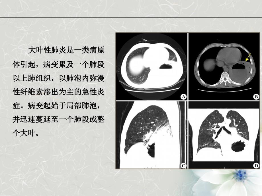 儿童大 叶性 肺炎_第3页