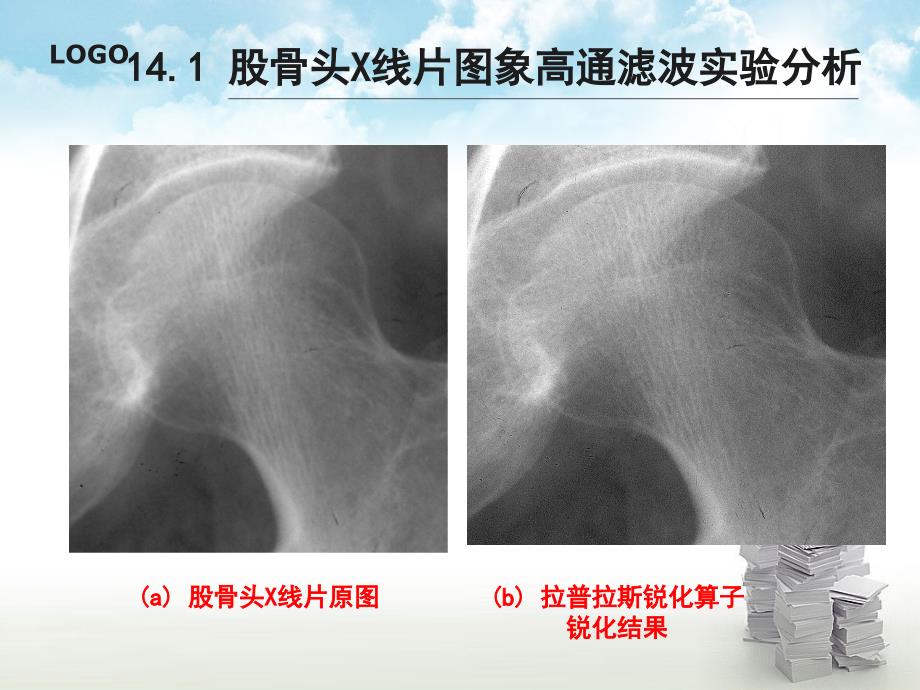 数字图像处理课件第14章基于空域运算的快速股骨头X线片图象增强方法_第2页