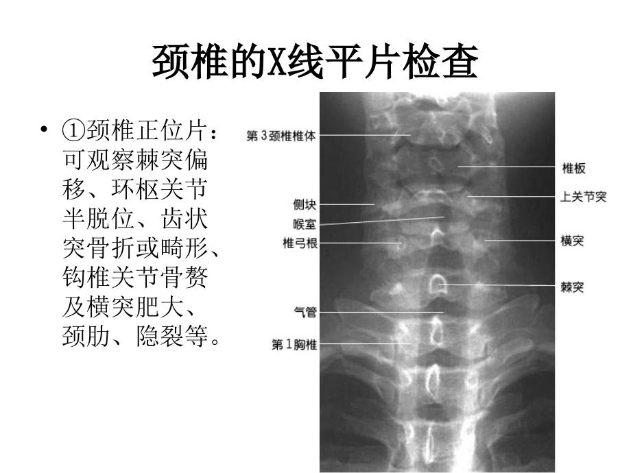 如何看颈腰 椎X 光片_第3页