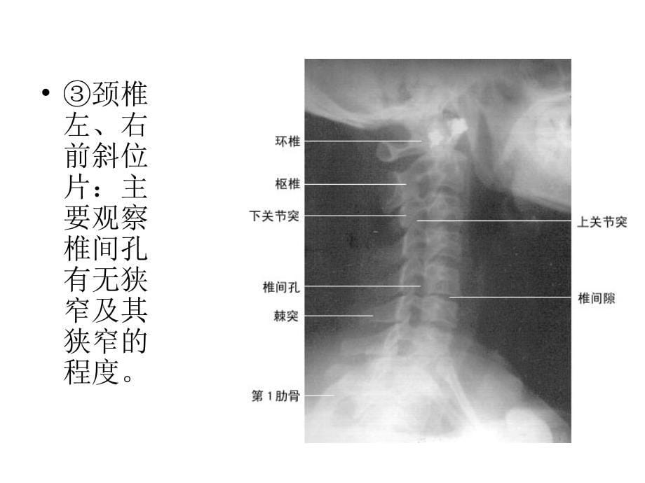 如何看颈腰 椎X 光片_第5页