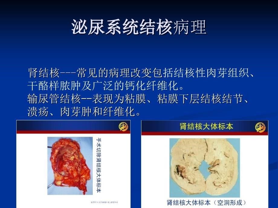 外科学泌尿、男生殖系结核_第5页