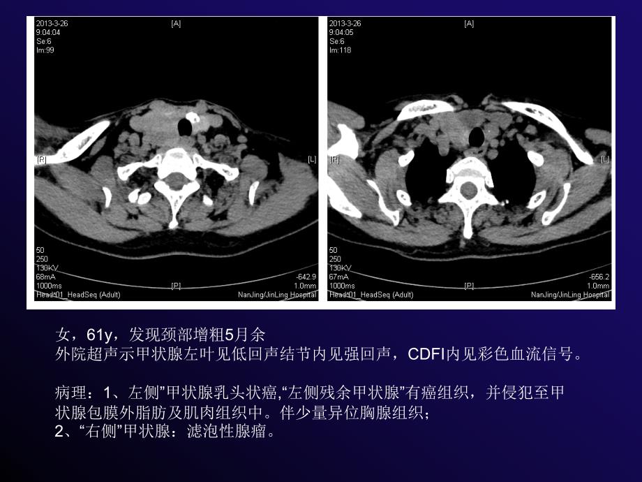 影像科甲状腺癌的CT诊断_第4页