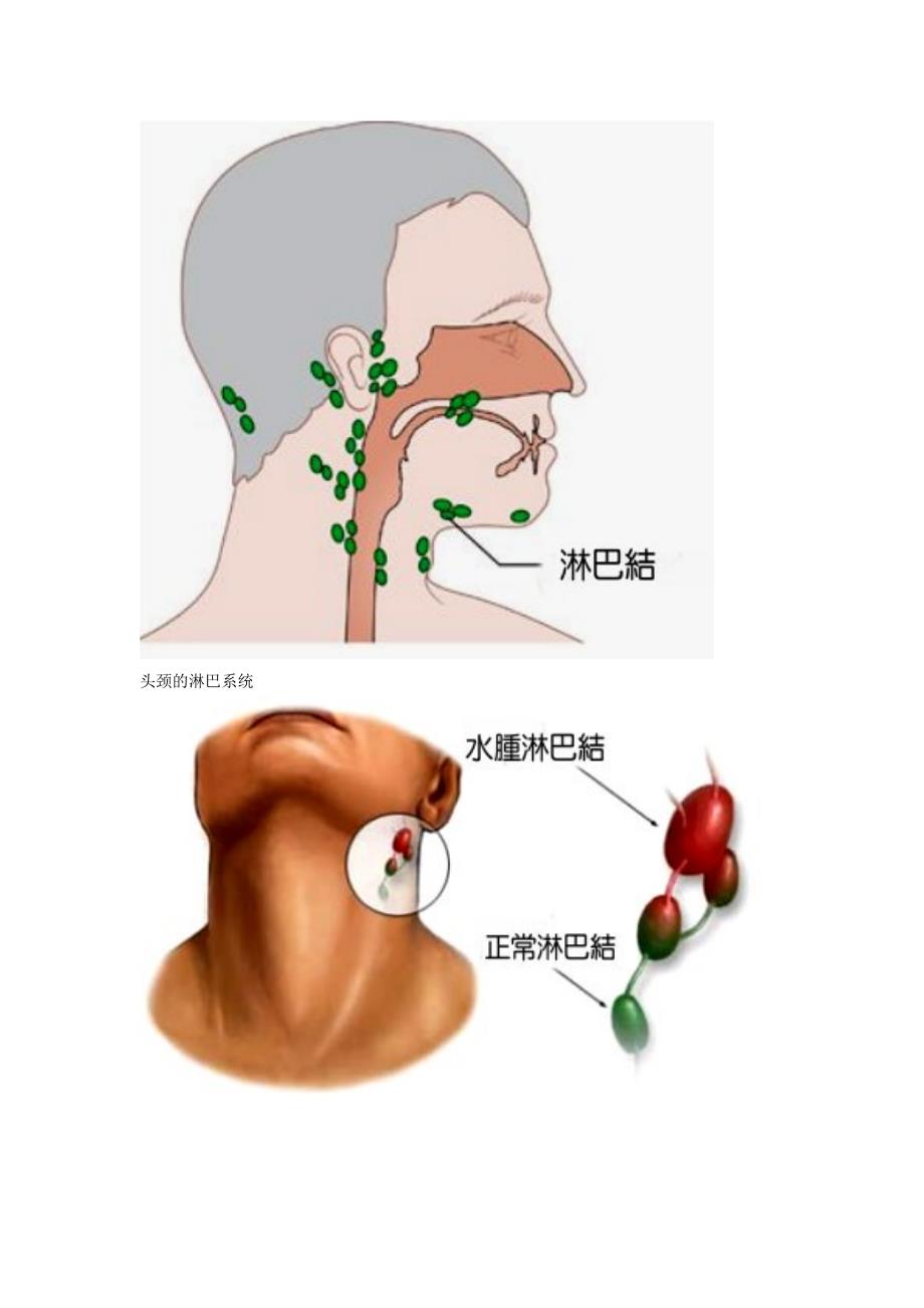 鼻咽癌的颈部淋巴结转移.总结_第3页
