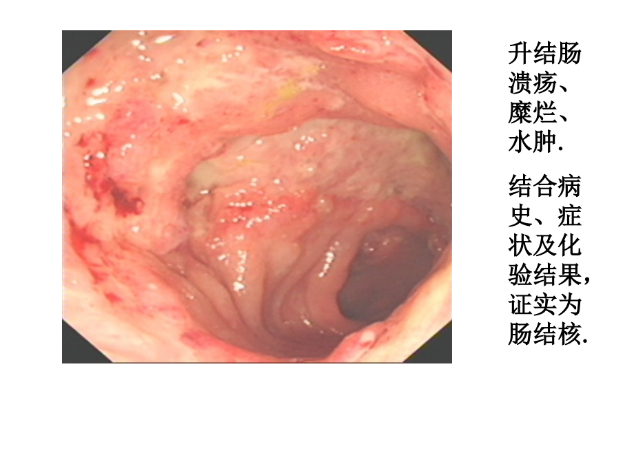 消化系统疾病腹部结核秦咏梅_第3页