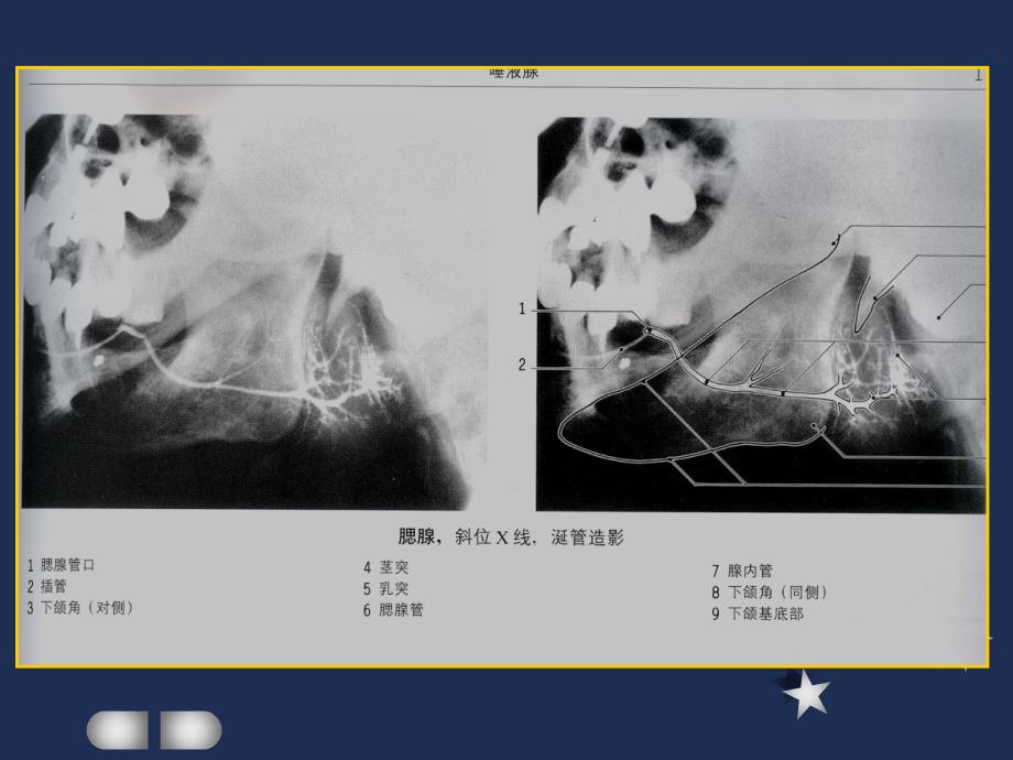 腮腺疾病的 影像 诊断_第3页