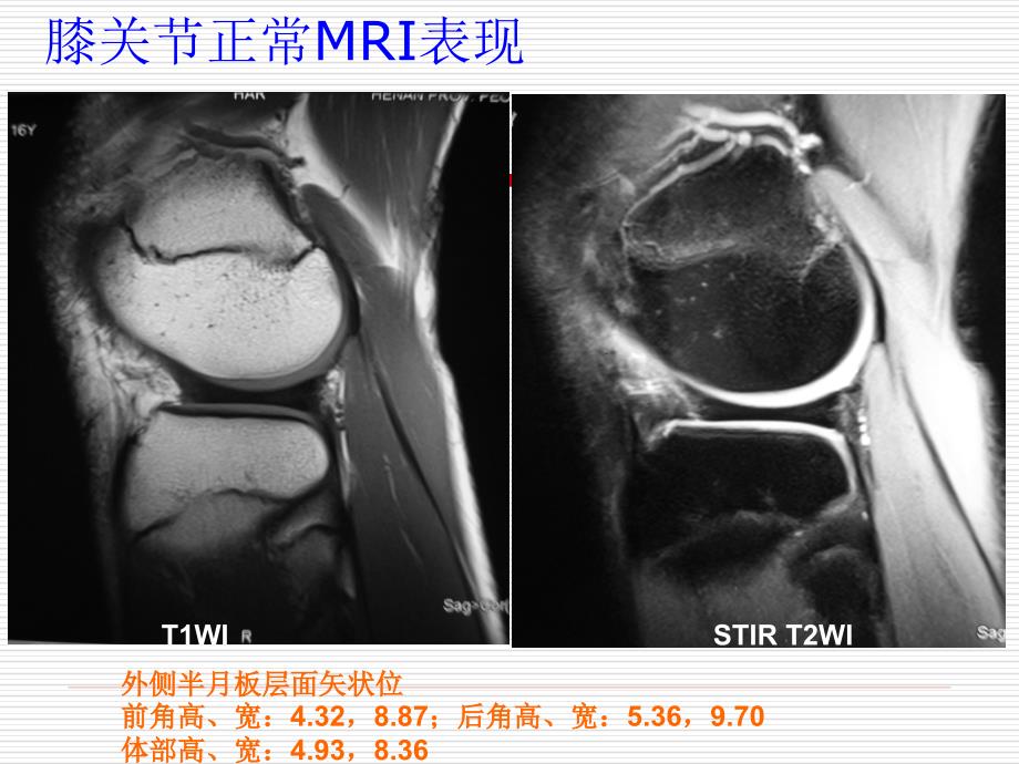 膝关节正常MRI表现及 损伤 诊断_第2页