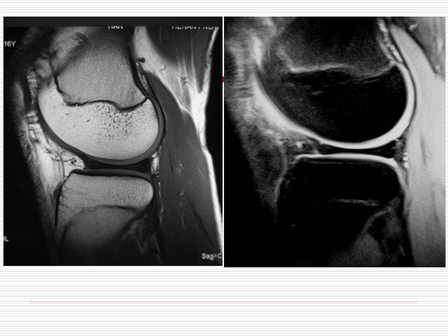 膝关节正常MRI表现及 损伤 诊断_第3页
