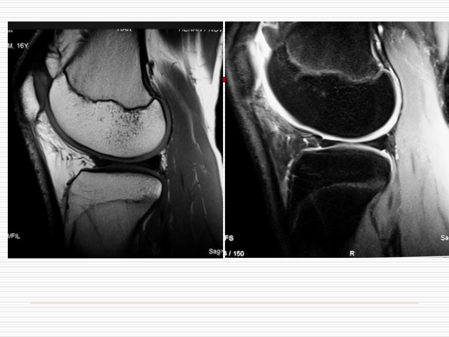 膝关节正常MRI表现及 损伤 诊断_第4页