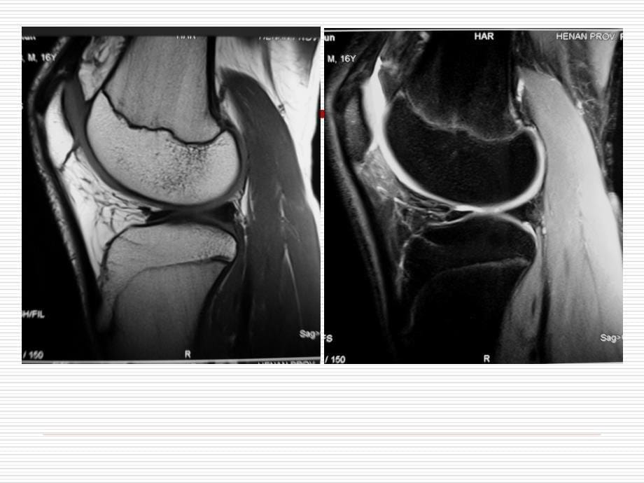 膝关节正常MRI表现及 损伤 诊断_第5页