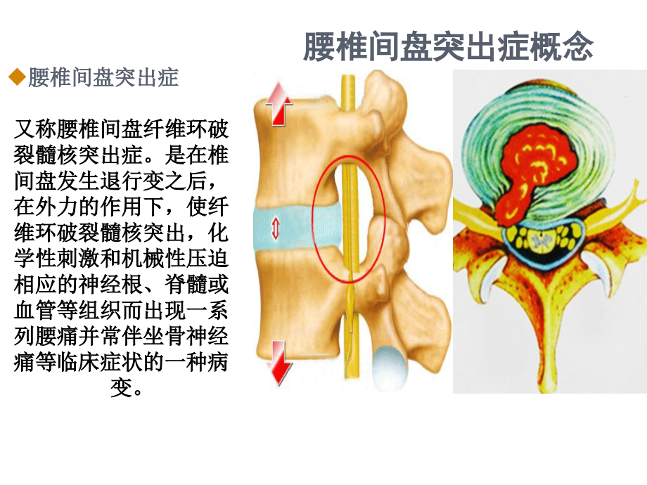 腰椎间盘突出症的临床分 型与 治疗_第4页