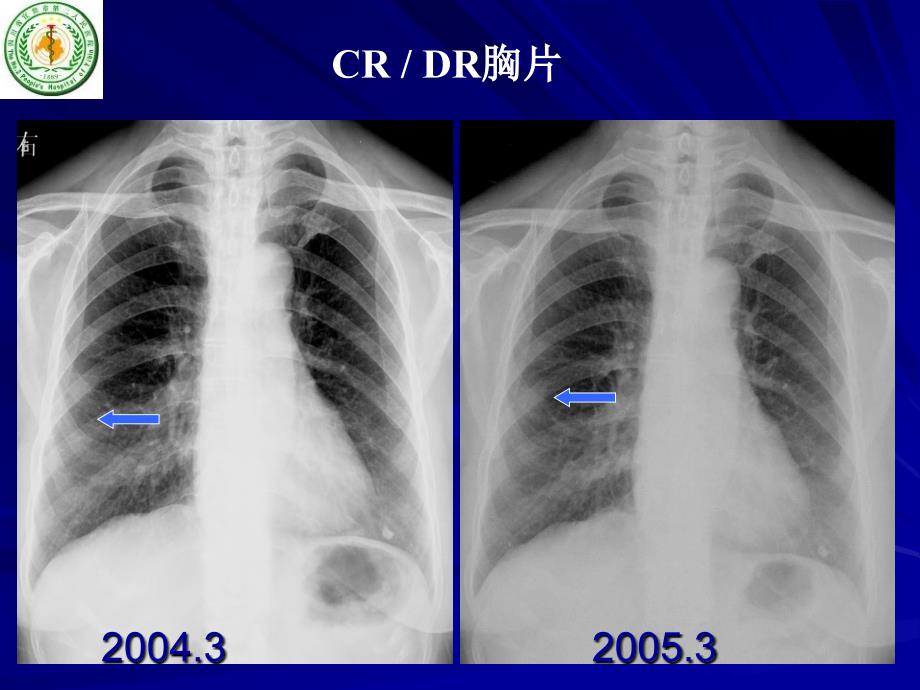 肺磨玻璃结节 CT 诊断_第4页