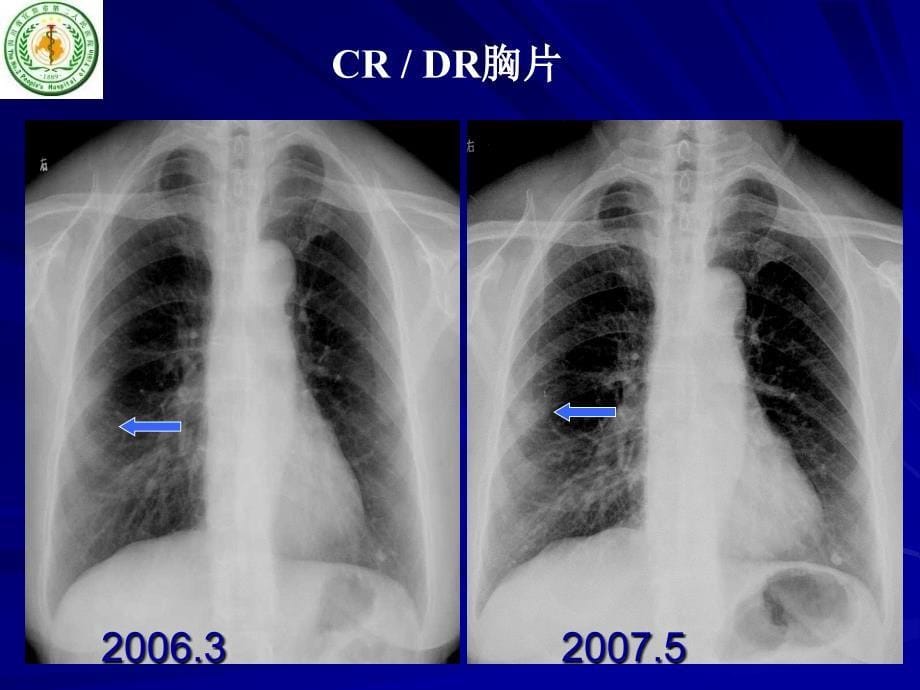肺磨玻璃结节 CT 诊断_第5页