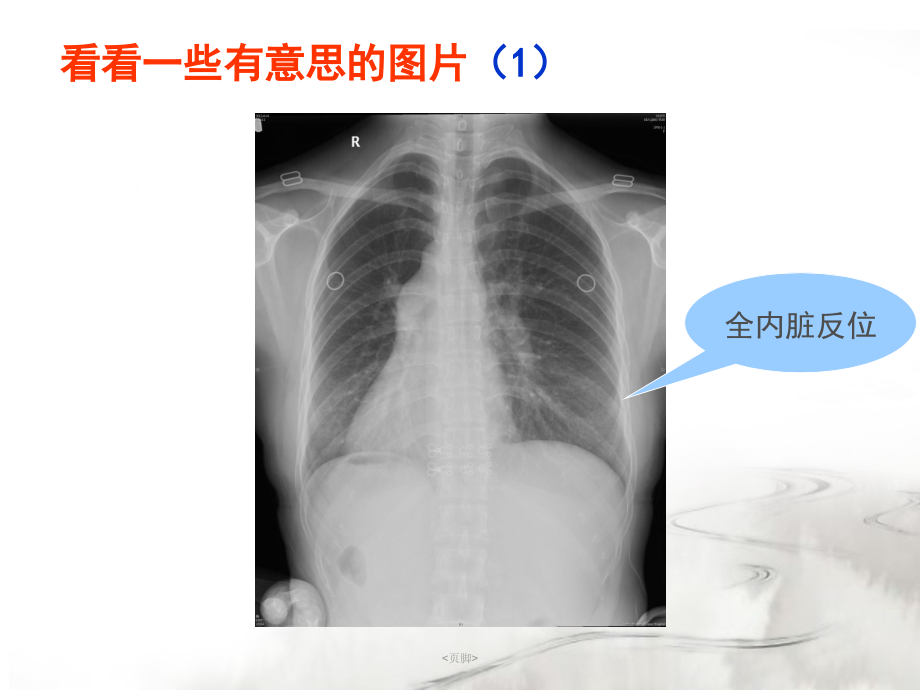 腮腺常见疾病的CT诊断 -王 传彬_第2页