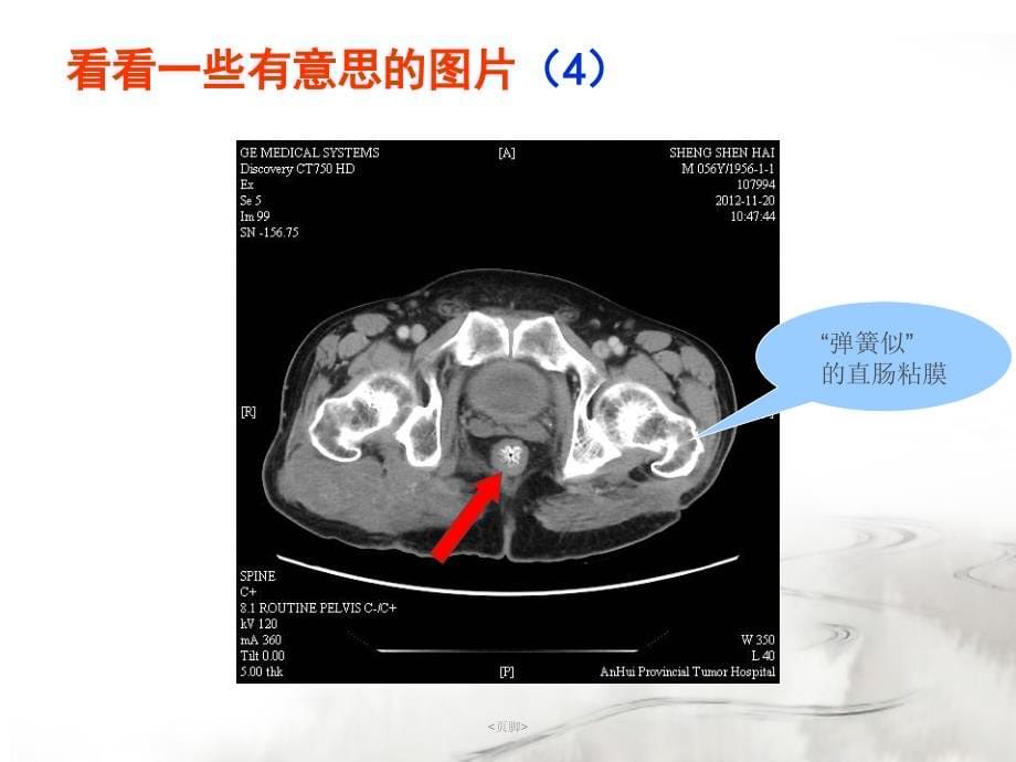 腮腺常见疾病的CT诊断 -王 传彬_第5页