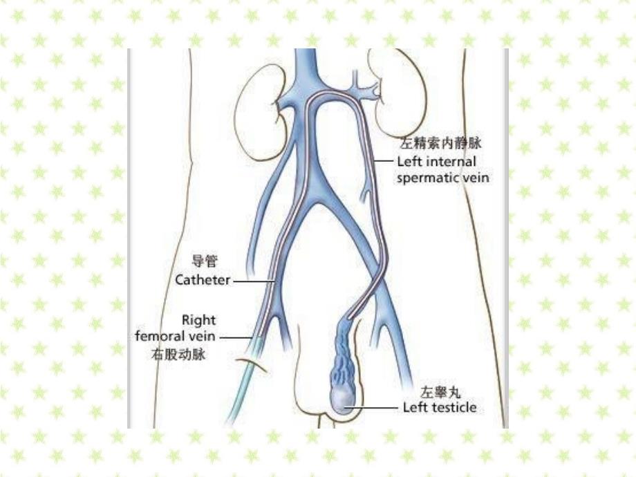 精索静脉曲张 (2)_第3页