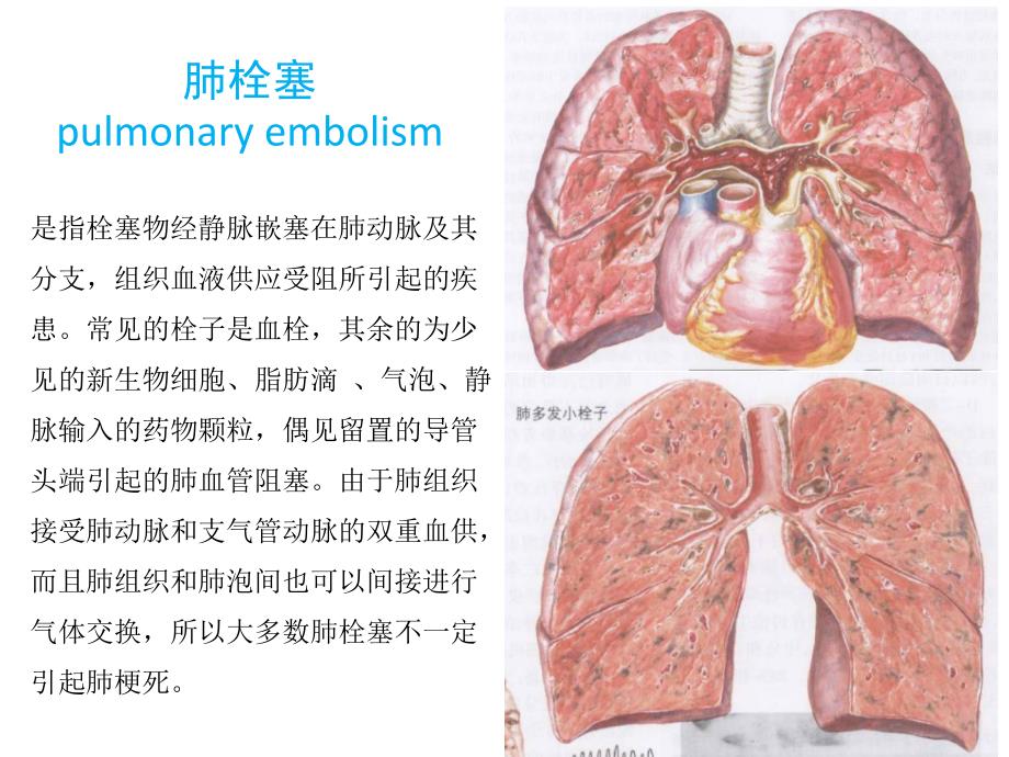 关于肺栓塞幻灯片_第2页