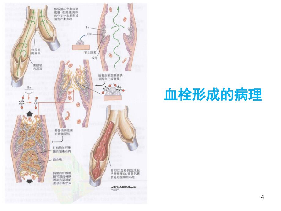 关于肺栓塞幻灯片_第4页