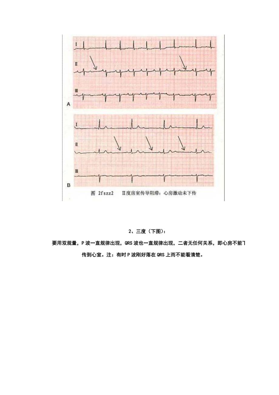 30分钟教你学会看心电图.doc_第3页