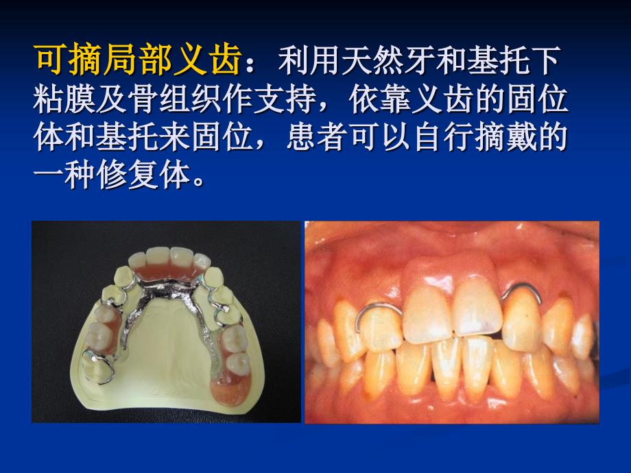 第三章 可摘局部义齿工艺技术_第3页