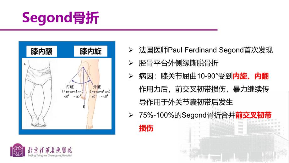 segond骨折与前交叉韧带损伤的影像学表现_第3页