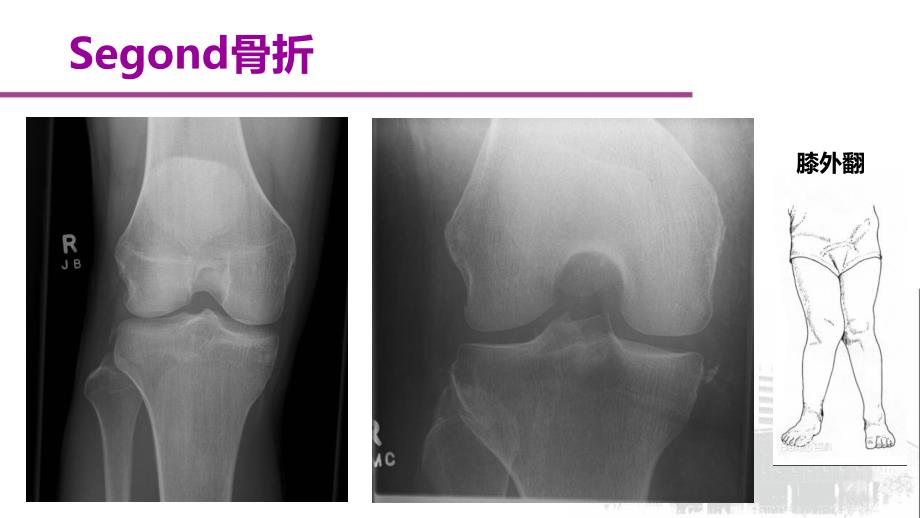 segond骨折与前交叉韧带损伤的影像学表现_第4页