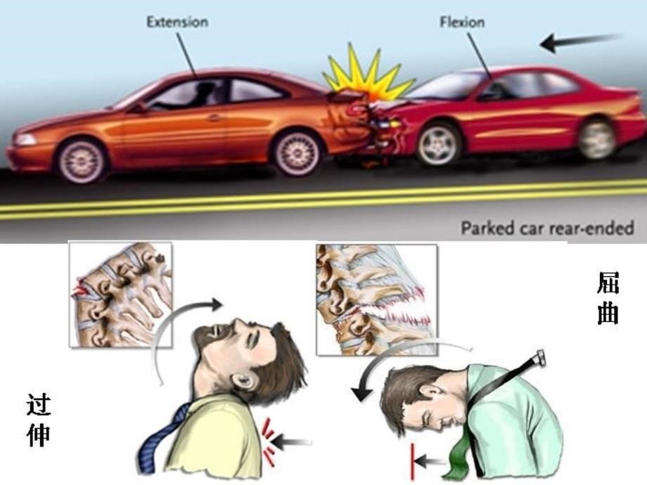 脊柱损伤的固定和搬运课件_第5页