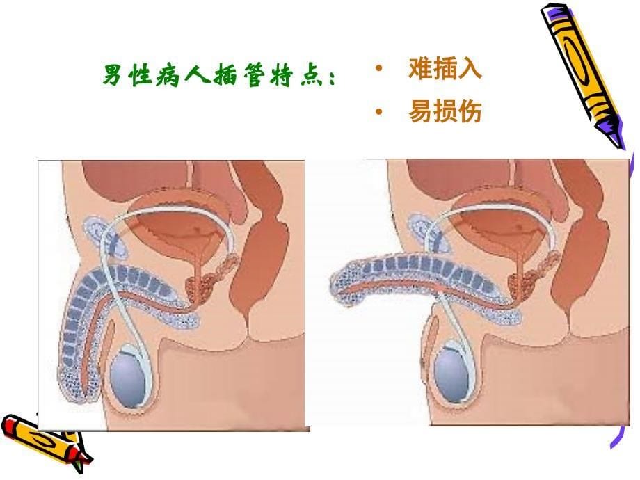 2013年导尿术  课件_第5页