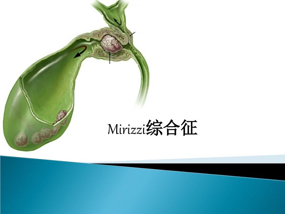 mirrizi综合征_第1页