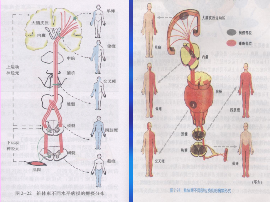 2018年脊髓疾病的定位和诊断课件_第4页