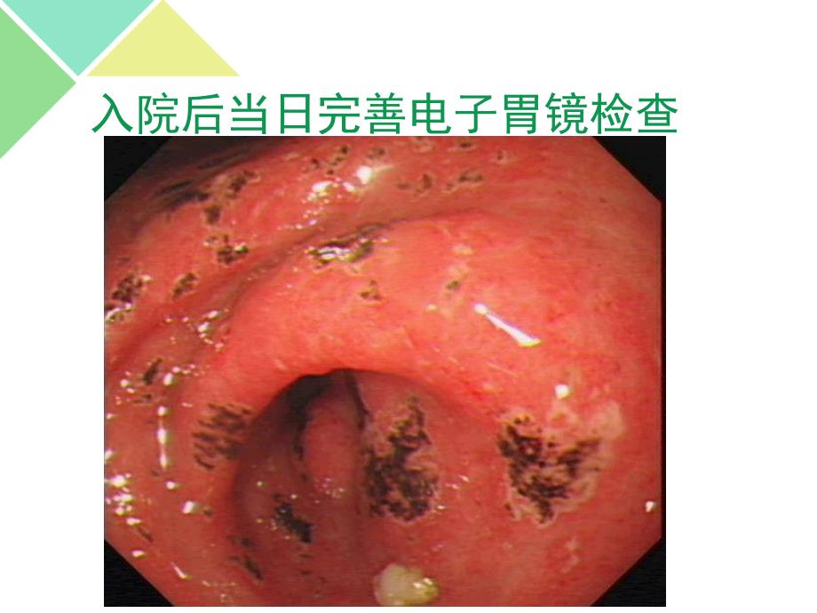 nasids相关胃肠道损伤的ppi临床应用_第3页