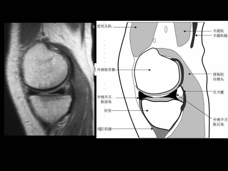 膝关节正常MRI表现与半月板病变_第4页