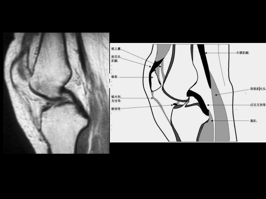 膝关节正常MRI表现与半月板病变_第5页
