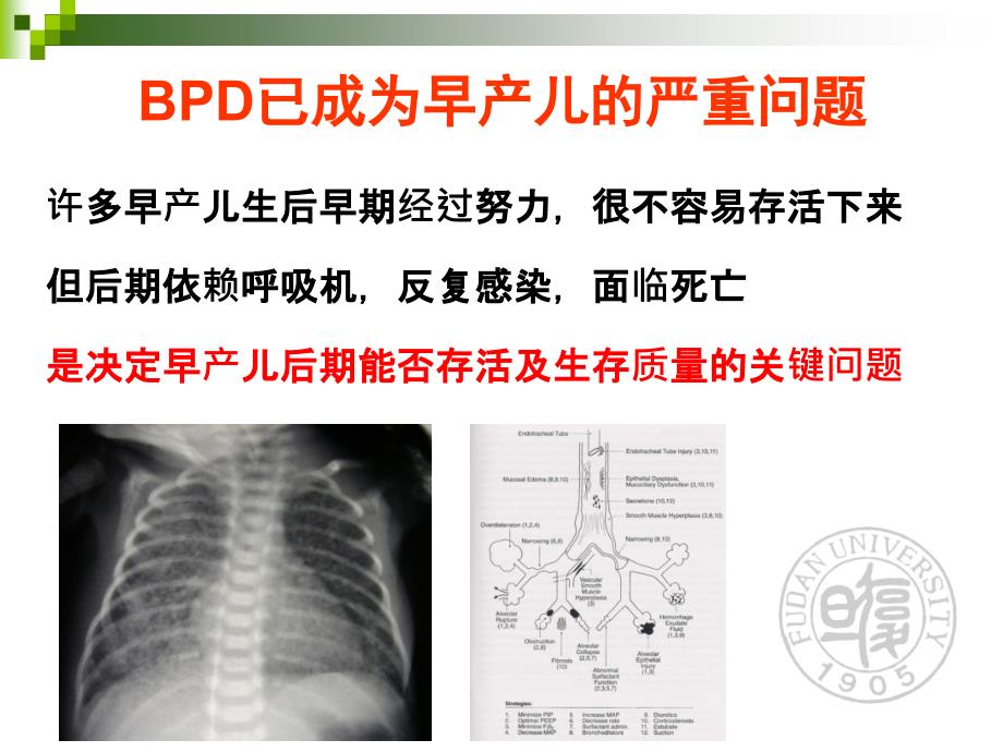 激素防治早产儿bpd的研究进展-陈超2018_第2页