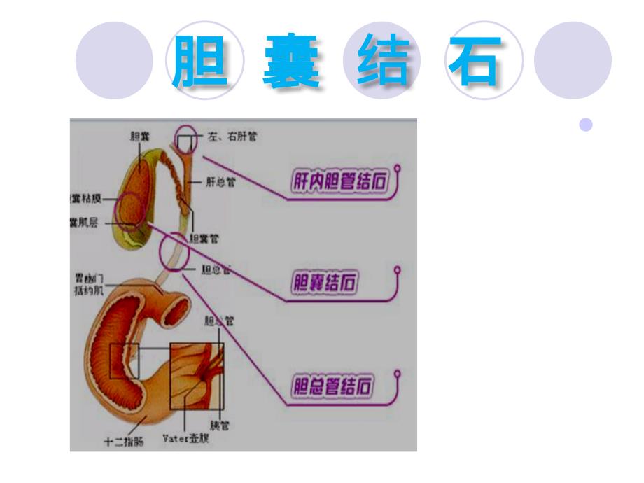 胆囊结石护理培训教程_第1页