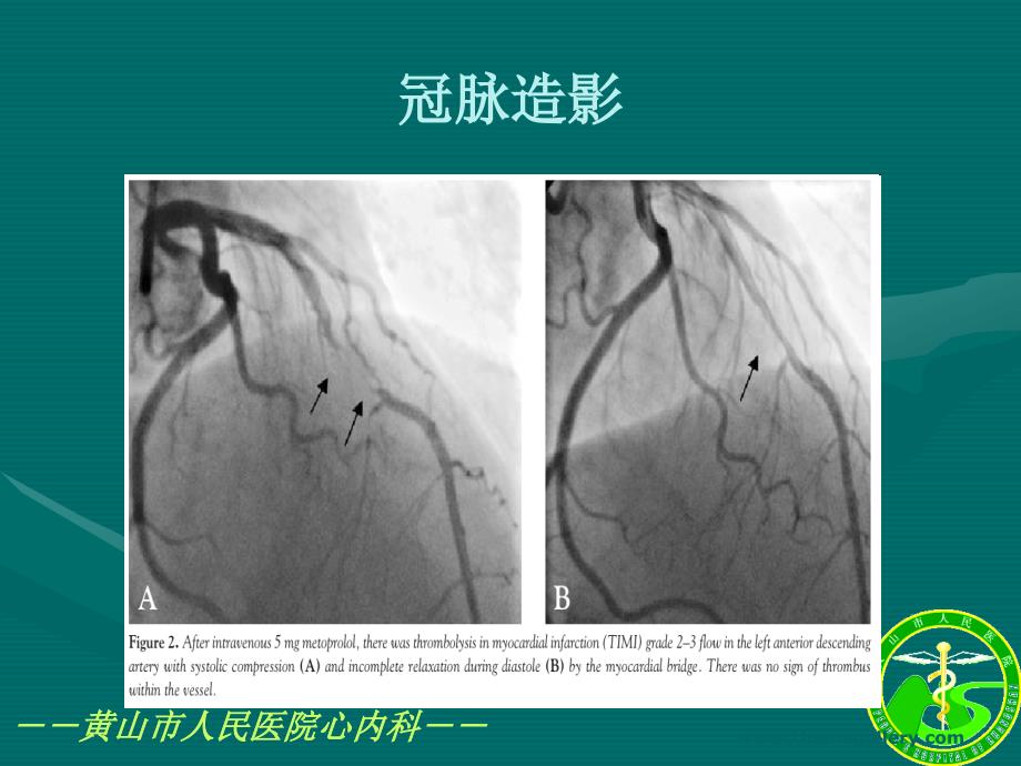 冠状动脉疾病医疗管理知识分析_第4页