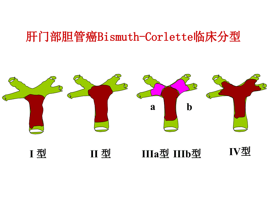 大会发言肝门部胆管癌_第3页