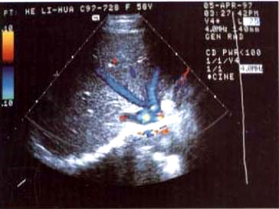 超声诊断学-1肝脏_第2页