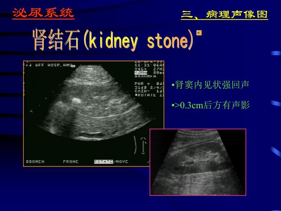 泌尿系统的超声诊断2_第4页