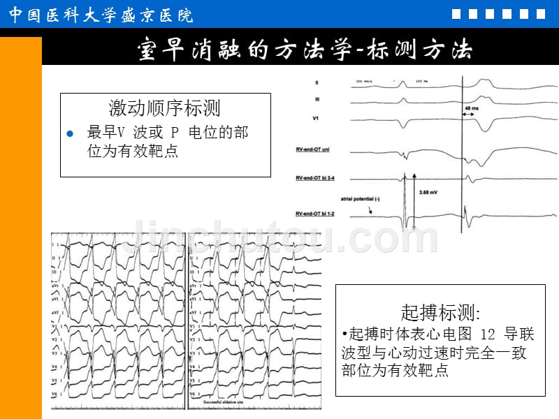 室性早搏消融治疗的适应症、方法学与争议(-37)_第3页