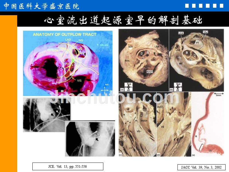 室性早搏消融治疗的适应症、方法学与争议(-37)_第4页